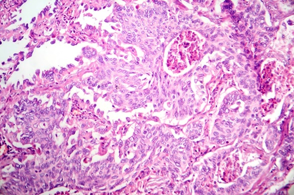 Image: AI outperformed expert pathologists in predicting which lung cancer cases are likely to metastasize (Photo courtesy of Shutterstock/Kateryna Kon)